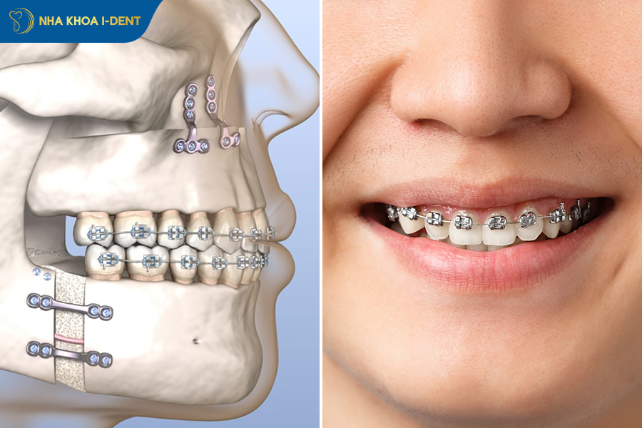kết hợp niềng răng và phẫu thuật chỉnh lệch hàm