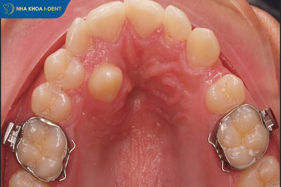 đặt khâu niềng răng là gì