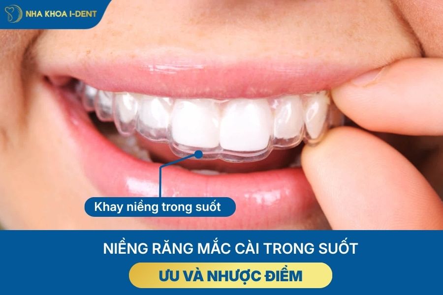 các loại mắc cài