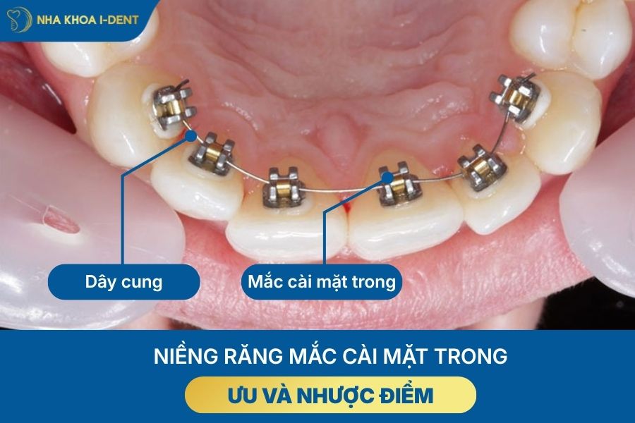 các loại mắc cài