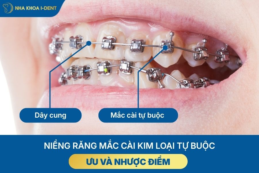 các loại mắc cài