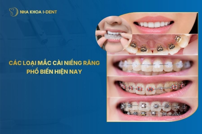 Các loại mắc cài niềng răng: Phân loại, ưu nhược điểm, giá