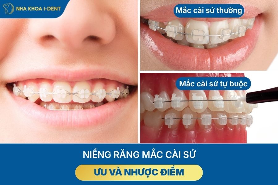 các loại mắc cài