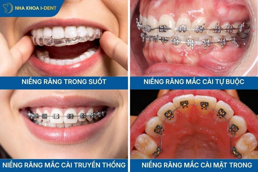 mức độ đau giữa các phương pháp niềng