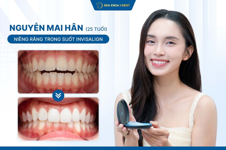 HÀNH TRÌNH NIỀNG RĂNG CỦA KHÁCH HÀNG NGUYỄN MAI HÂN: NIỀNG RĂNG INVISALIGN ĐỂ THĂNG TIẾN TRONG SỰ NGHIỆP MẪU ẢNH