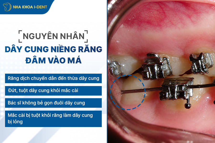 nguyên nhân dây cung niềng răng đâm vào má