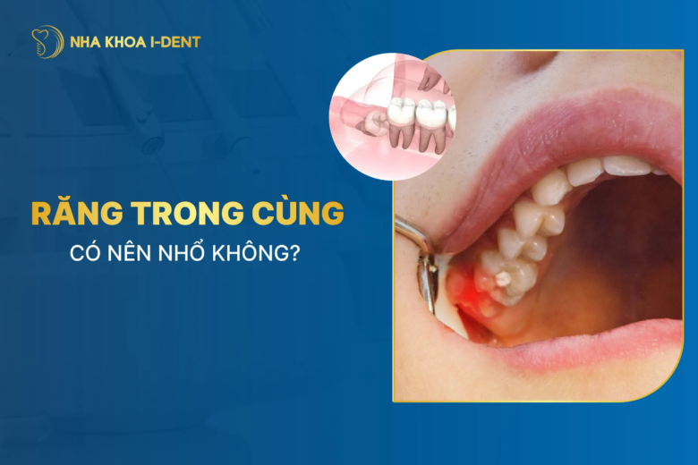 Răng trong cùng có nên nhổ bỏ không? Giải đáp chi tiết