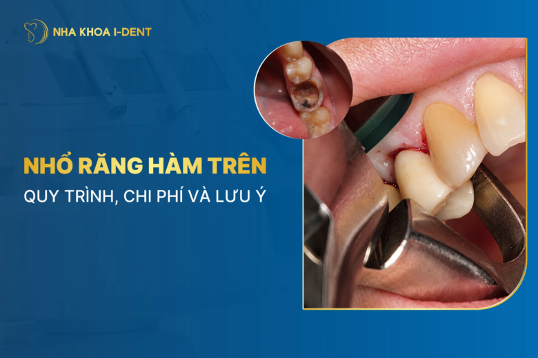 Nhổ răng hàm trên: Quy trình, chi phí và lưu ý 