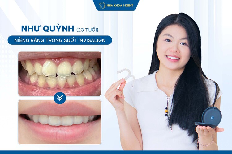HÀNH TRÌNH NIỀNG RĂNG CỦA KHÁCH HÀNG NHƯ QUỲNH: TỰ TIN, THOẢI MÁI VÀ THẨM MỸ VỚI KHAY NIỀNG TRONG SUỐT INVISALIGN