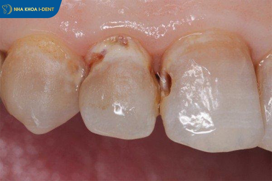 những tác hại của việc không nhổ răng sâu