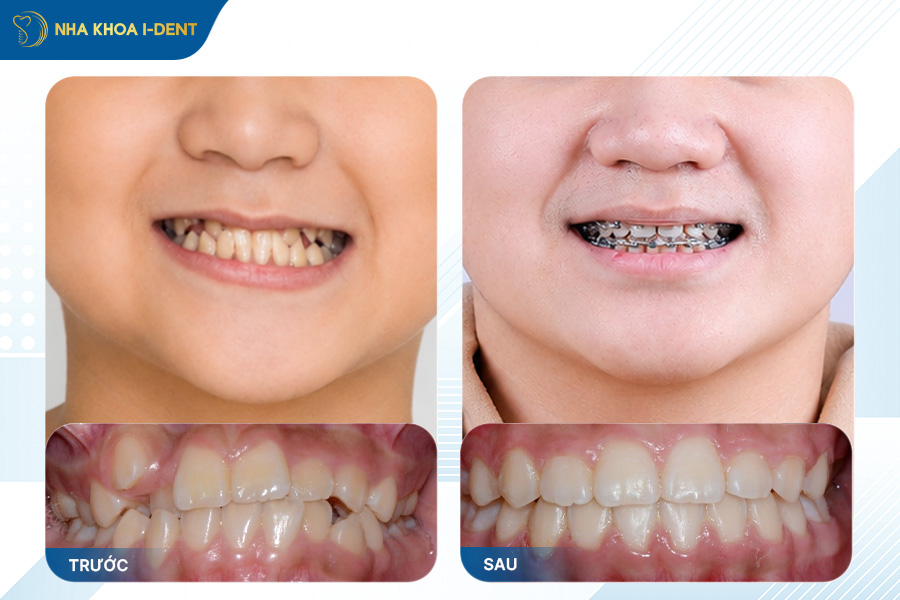 khách hàng niềng răng chỉnh lệch hàm tại nha khoa i-dent