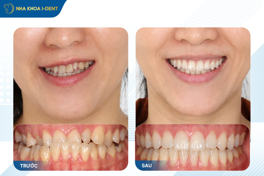 khách hàng niềng răng chỉnh lệch hàm tại nha khoa i-dent