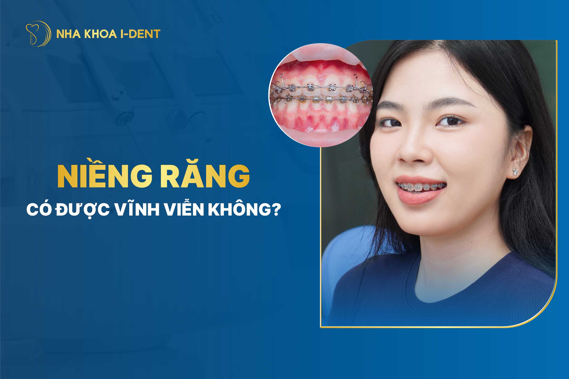 Niềng răng có được vĩnh viễn không? Nha khoa I-Dent