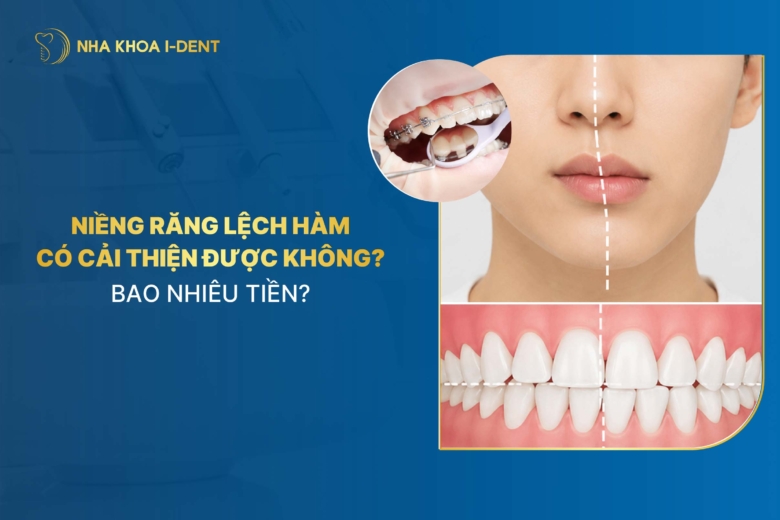 Niềng răng lệch hàm có cải thiện được không? Bao nhiêu tiền?