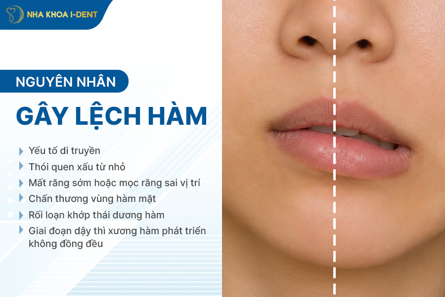 niềng răng lệch hàm bao nhiêu tiền