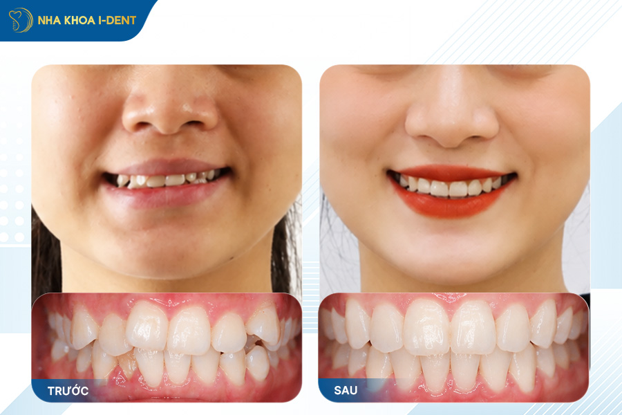 khách hàng niềng răng chỉnh lệch hàm tại nha khoa i-dent