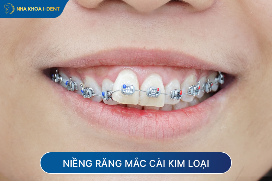 niềng răng có được vĩnh viễn không