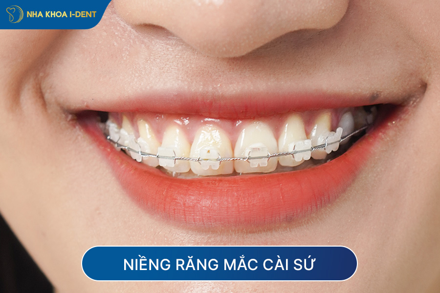 niềng răng có được vĩnh viễn không