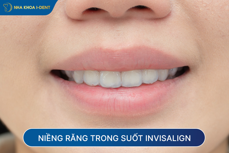 niềng răng có được vĩnh viễn không