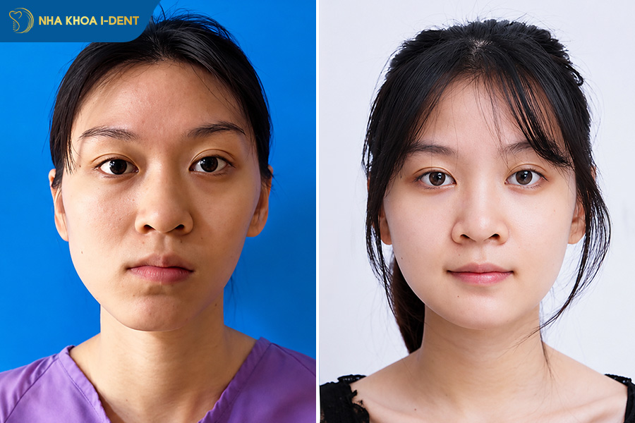 phẫu thuật chỉnh lệch hàm