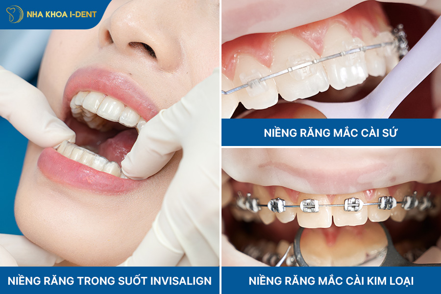 phương pháp niềng răng lệch hàm