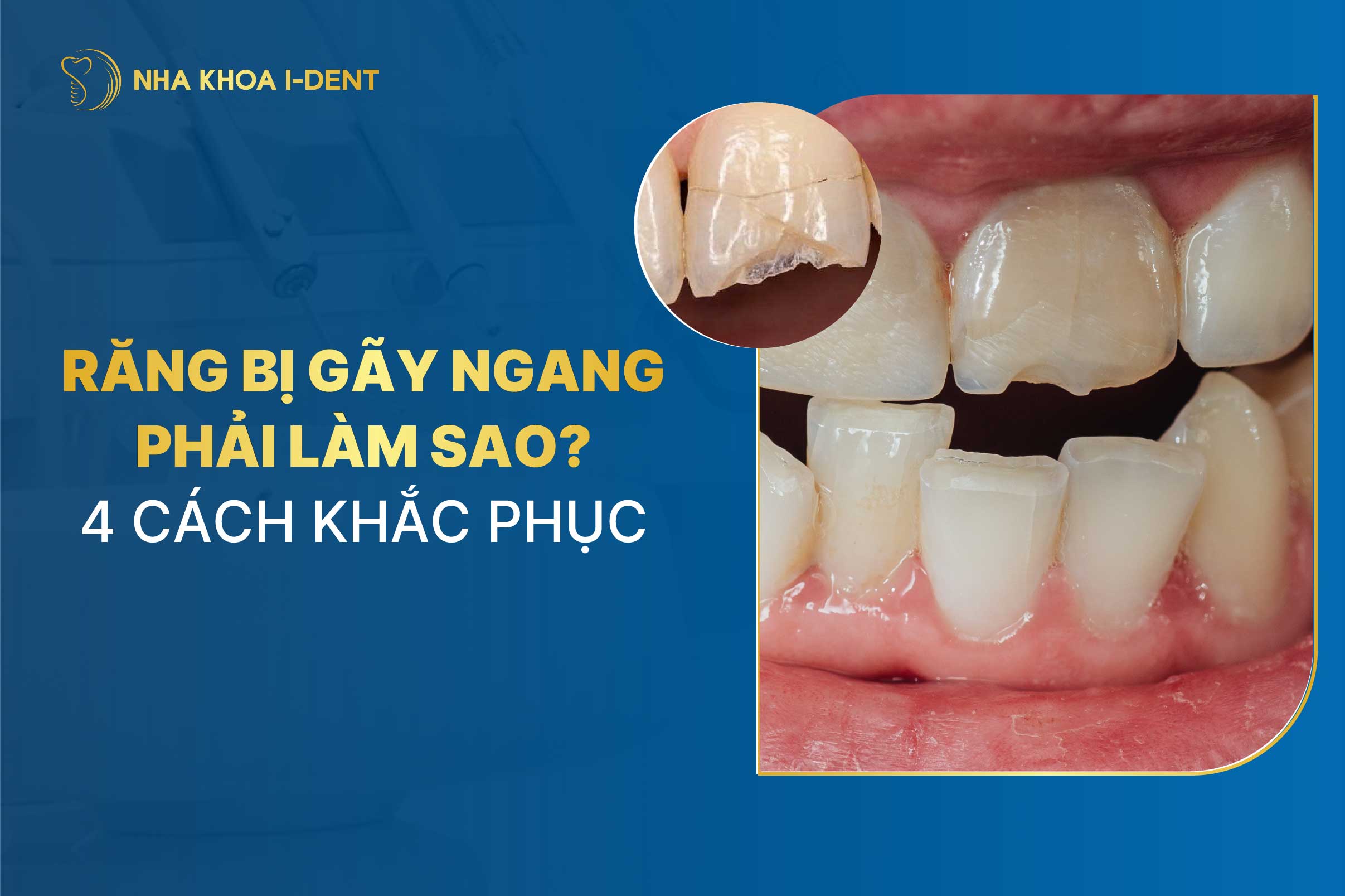Răng bị gãy ngang phải làm sao? Cách xử lý và khắc phục