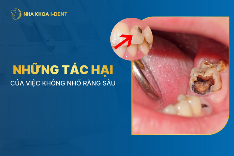 5 tác hại của việc không nhổ răng sâu cần biết