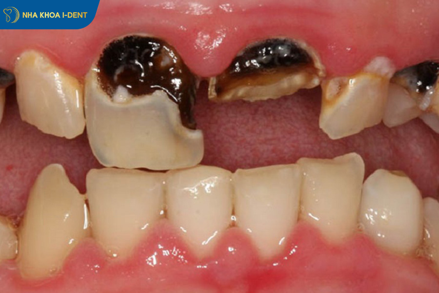 tác hại của việc nếu không nhổ răng sâu