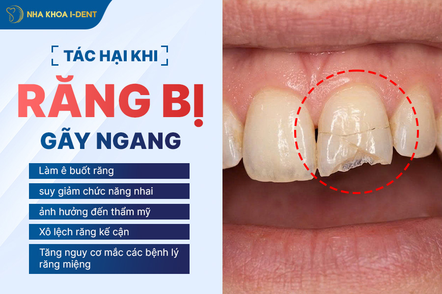 tác hại khi răng bị gãy ngang