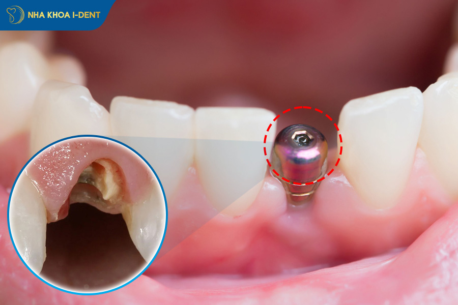 trồng răng implant