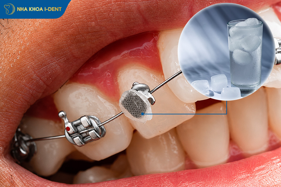 uống nước đá có thể làm ninh mắc cài
